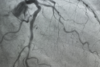 A rare case of double coronary artery fistula from left circumflex artery draining to the left atrium in a rheumatic heart disease patient