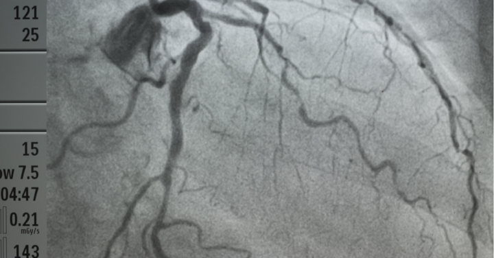 A rare case of double coronary artery fistula from left circumflex artery draining to the left atrium in a rheumatic heart disease patient