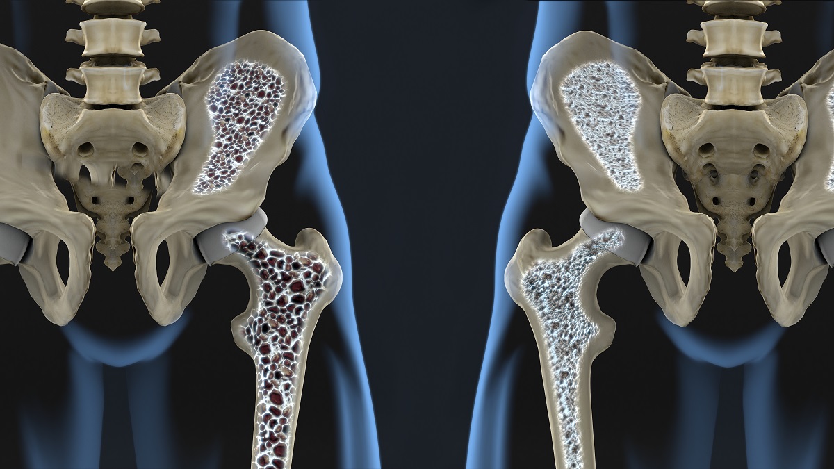 Какво представлява остеопорозата