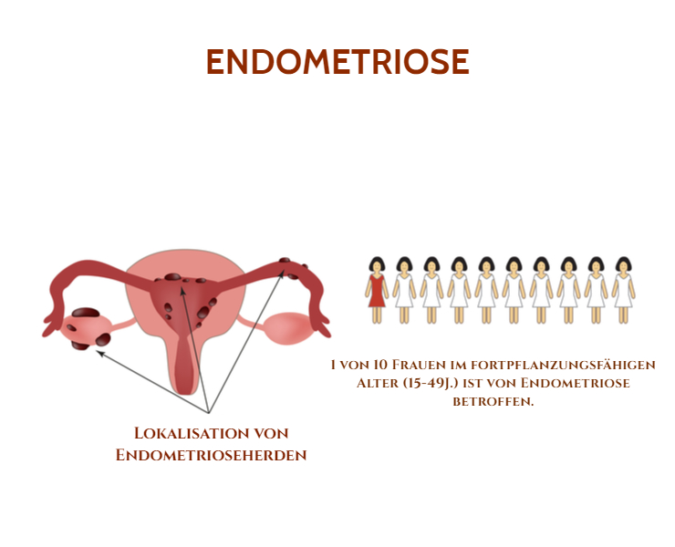 Endometriose - wie viele Frauen davon betroffen sind