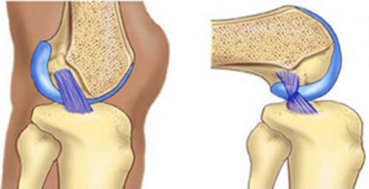 Clinical Outcome after Anterior Cruciate Ligament Reconstruction Using Hamstring Tendon Autograft: A Prospective Study with 6 Months Follow-Up