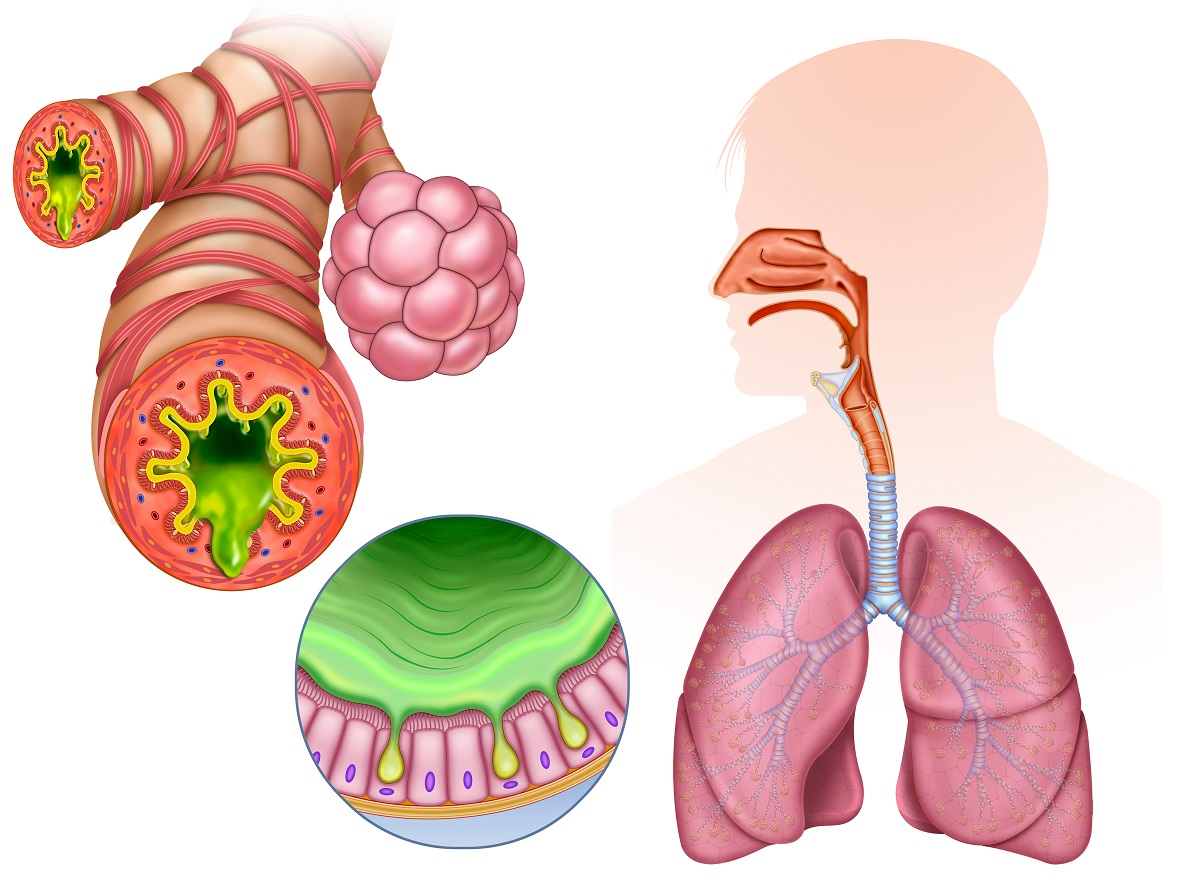 бронхитът е заболяване на дихателната система
