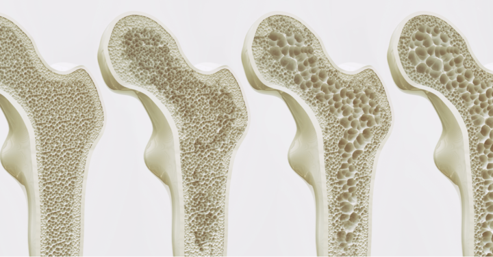 Transient osteoporosis of the talus: A case report
