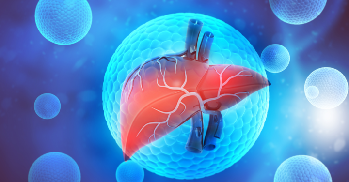 Fatty liver and risks for cirrhosis and cancer