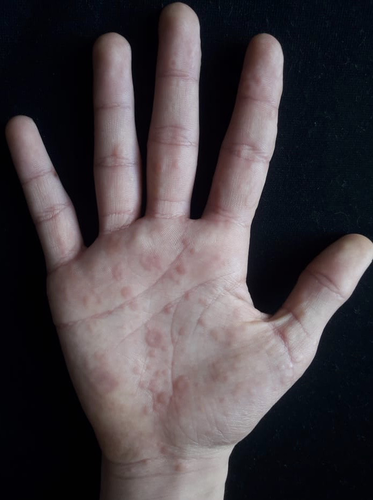 Atypical erythema multiforme palmar plaques lesions due to Sars‐Cov‐2 ...